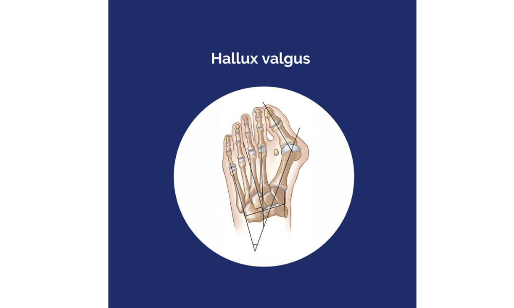 Právě si prohlížíte Hallux valgus – vbočený palec